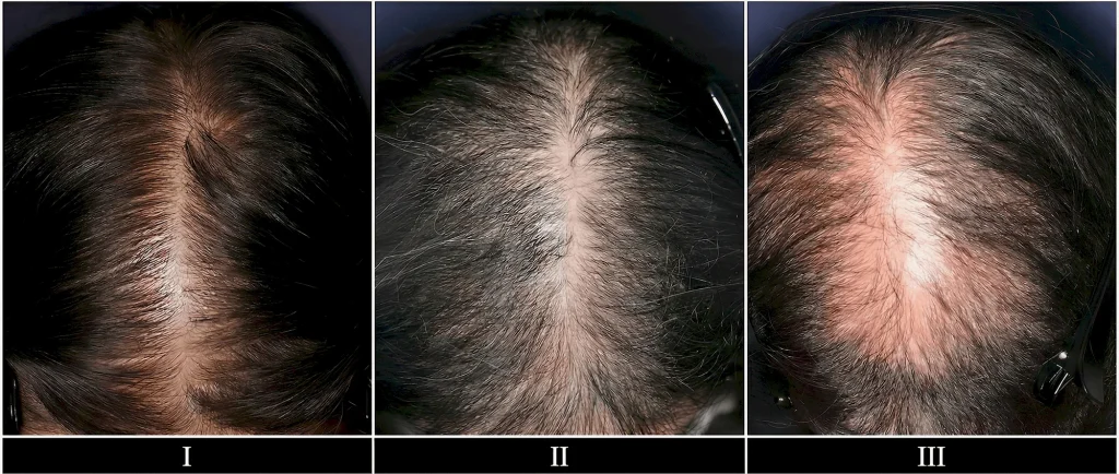 Ludwig scale showing stage I, II, and III hair thinning at the crown