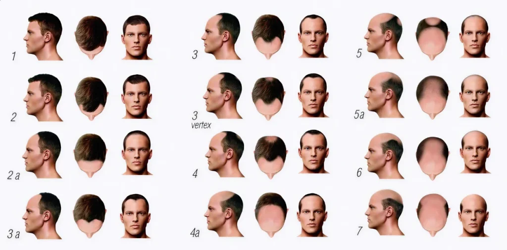 Hamilton-Norwood classification chart of male pattern hair loss stages