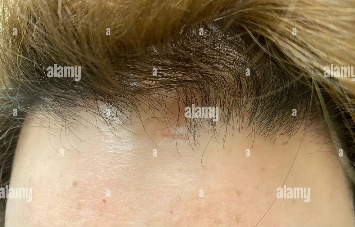 Frontal fibrosing alopecia in a female patient